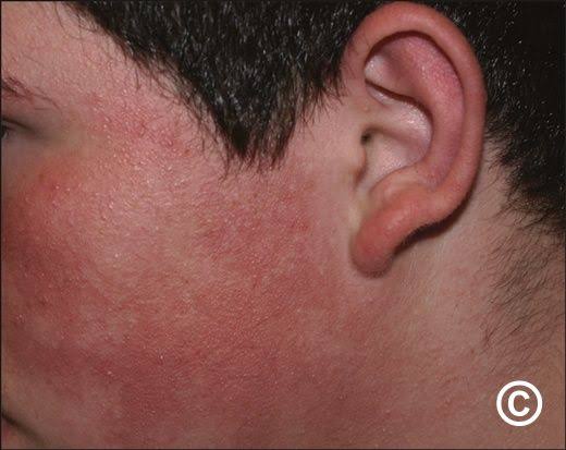 KPRF texture on cheek